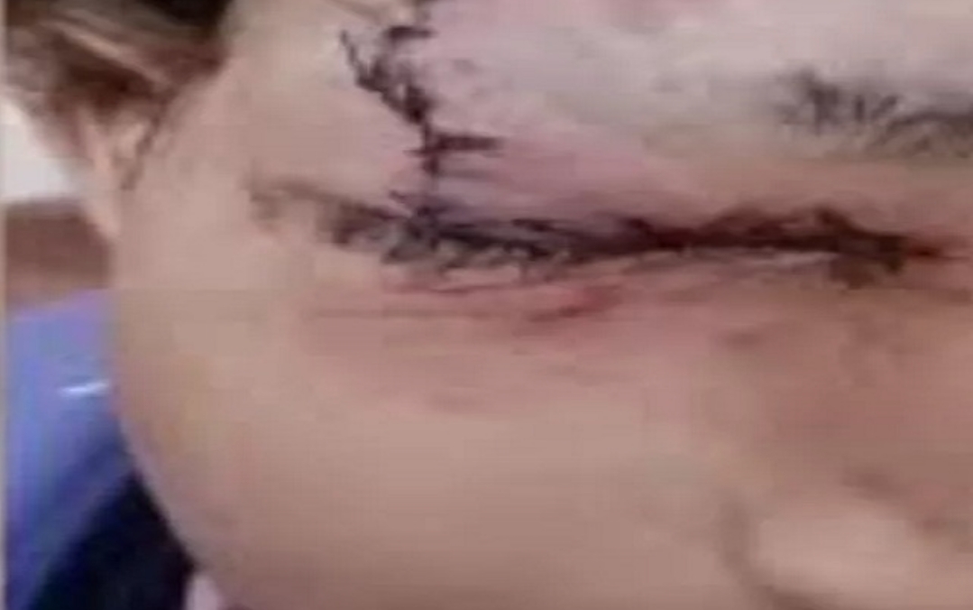 छात्र ने खेल-खेल में दोस्त की आंख में घुसा दी पैसिंल, स्कूल की छुट्टी के बाद लौट रहे थे घर